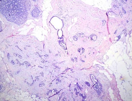 Warthin’s tumor (Salivary gland)