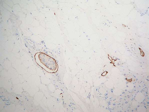cml07-cs4789 podoplanin 10x peripheral part