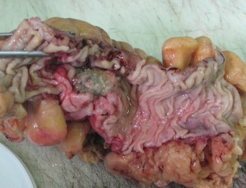 Carcinosarcoma (large intestine)