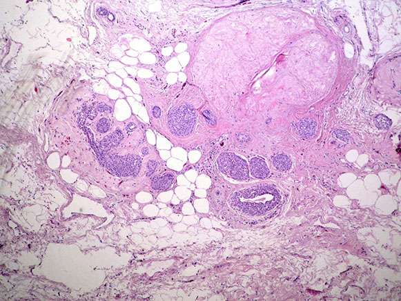 Figure 4 LCIS surrounding breast tissue