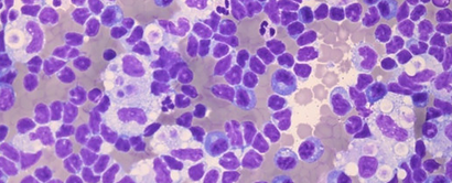 Ascitic fluid cytology showing lymphocytic predominant cells with foamy macrophages