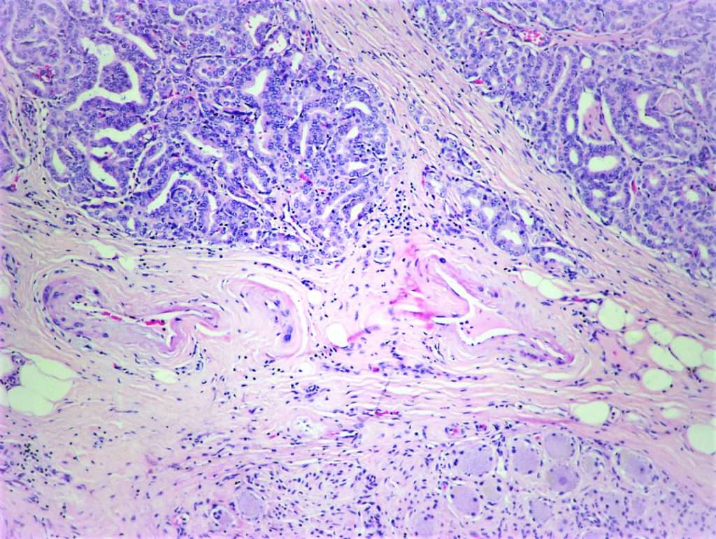 High-grade prostatic adenocarcinoma – BosnianPathology