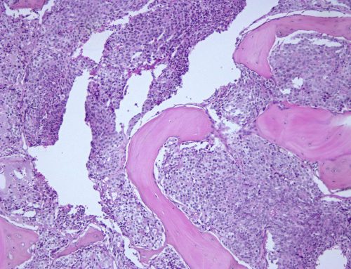High-grade prostate adenocarcinoma metastatic to bone