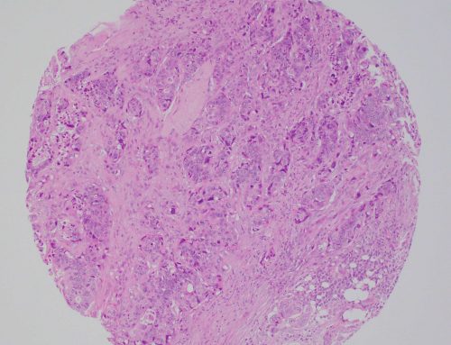 Poorly differentiated rectal adenocarcinoma