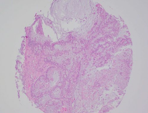 Mucinous adenocarcinoma (rectum)