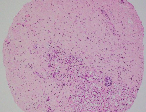 High-grade prostate adenocarcinoma with prominent cytoplasmic clearing (therapy effects?)