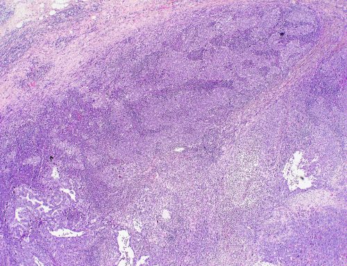 Invasive breast carcinoma with medullary features