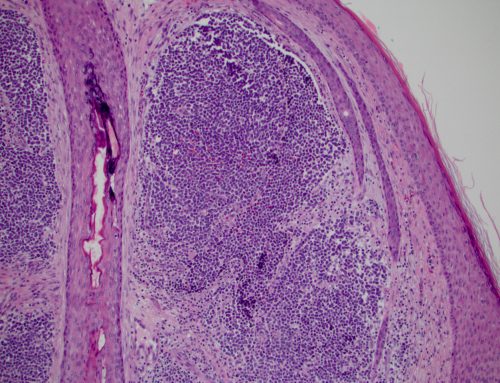 Merkel cell carcinoma (MCPyV negative)