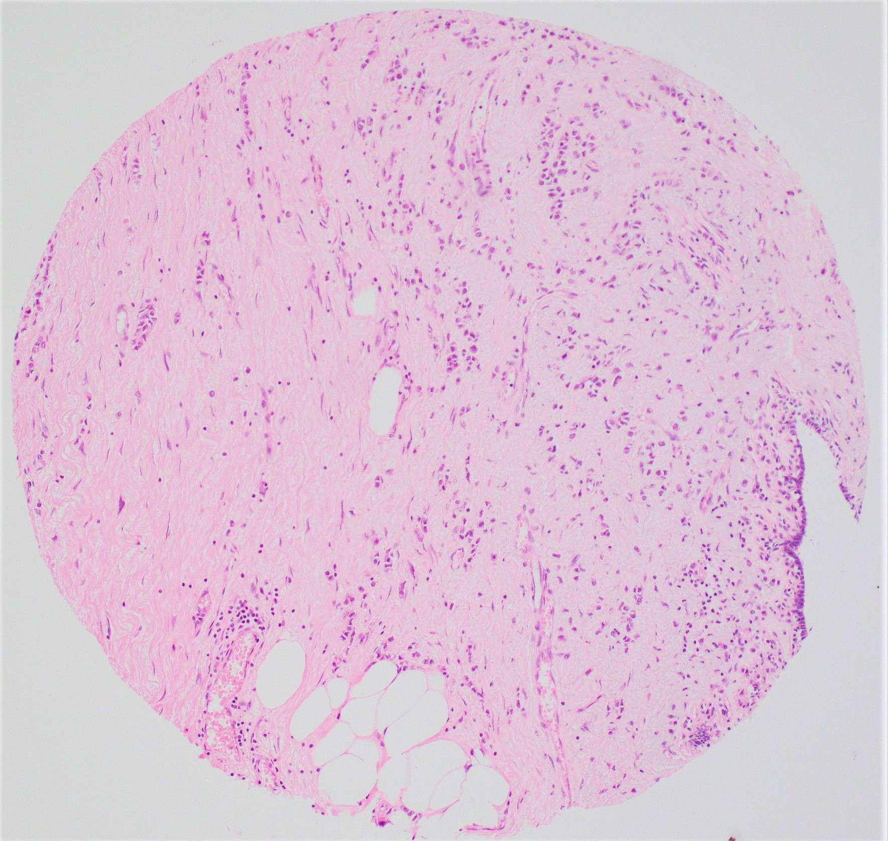 S11 2745 invasive lobular carcinoma 10x