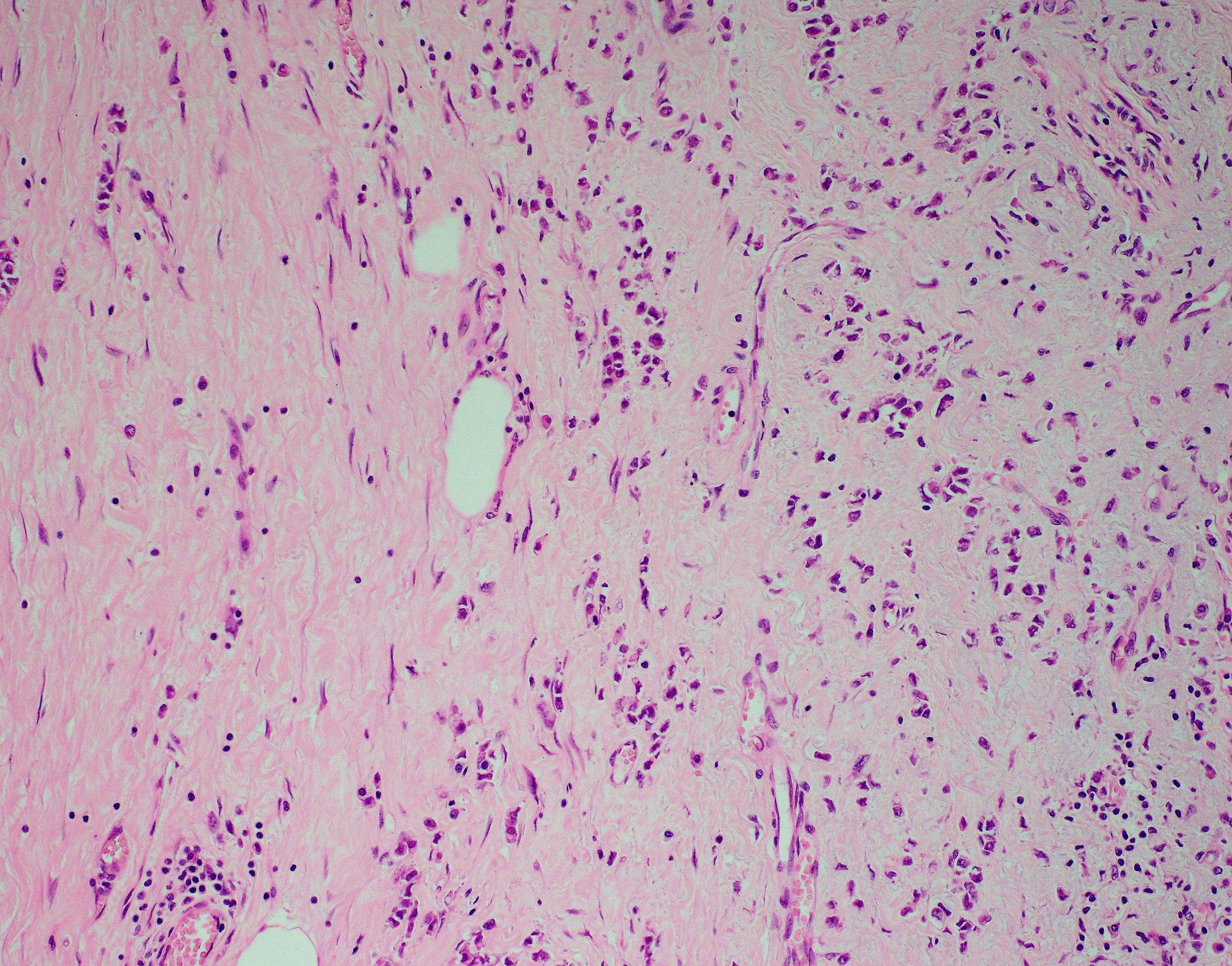 S11 2745 invasive lobular carcinoma 20x