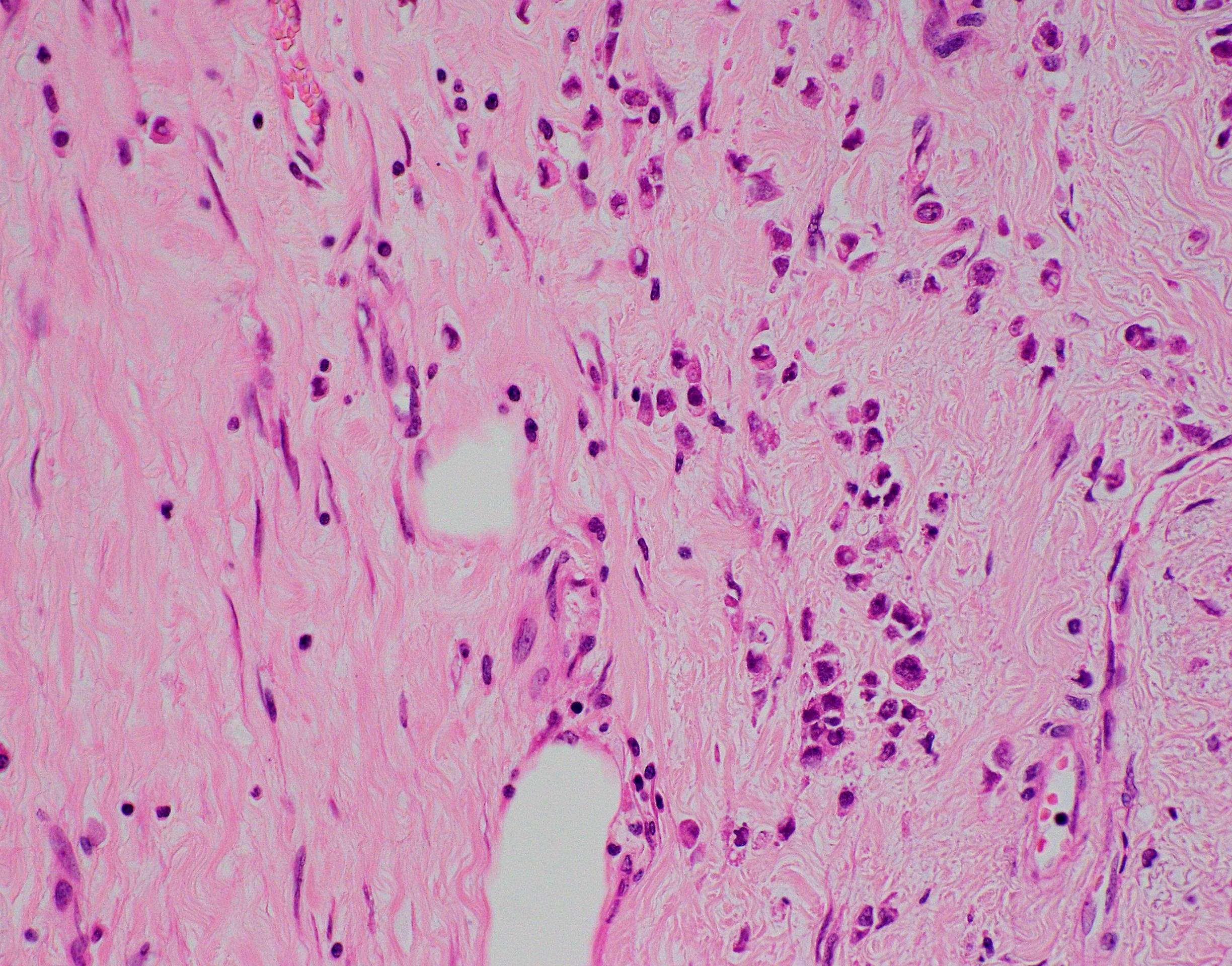 S11 2745 invasive lobular carcinoma 40x
