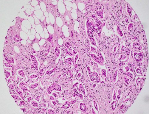 Micropapillary carcinoma with apocrine differentiation