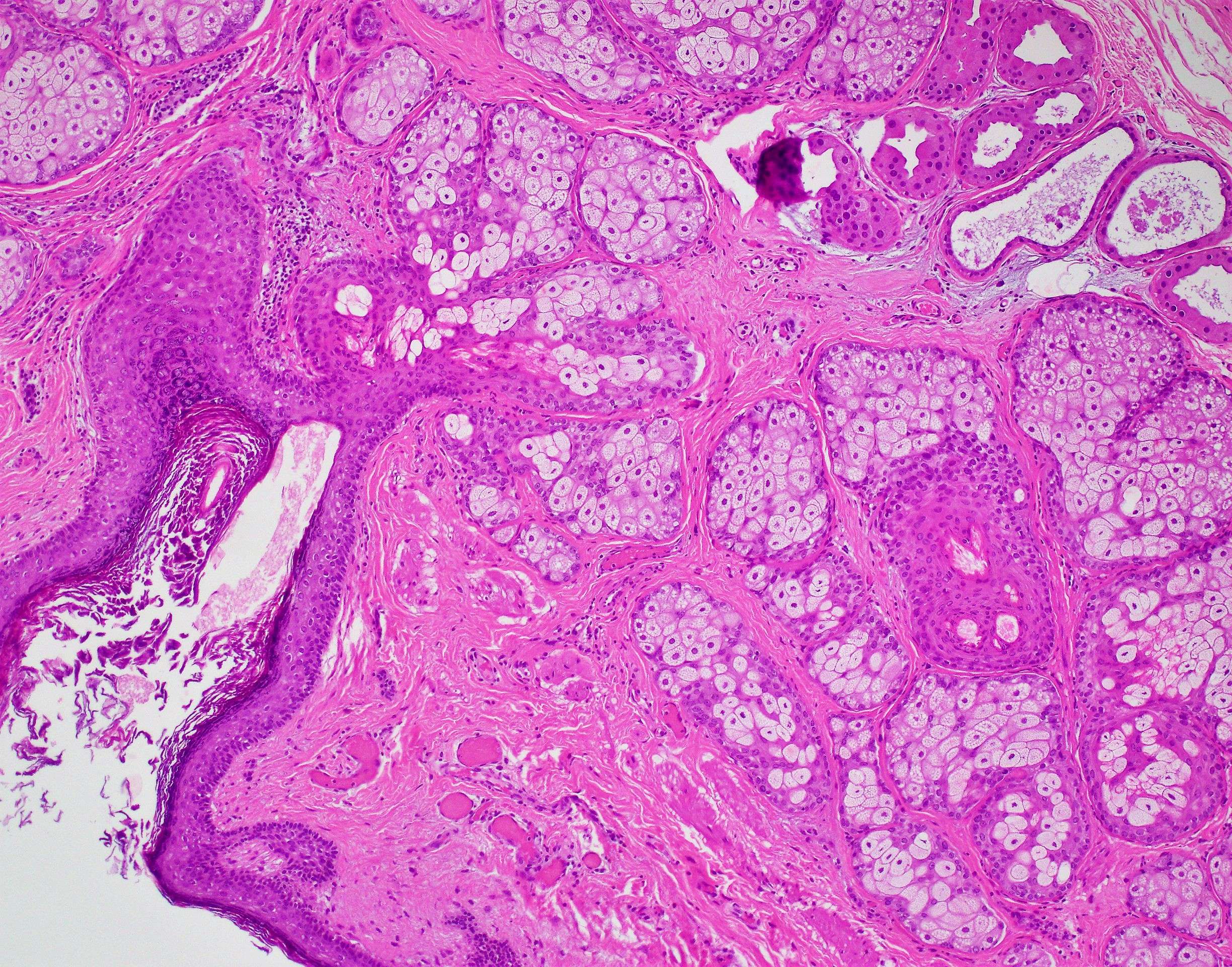 Cystic mature teratoma 10x