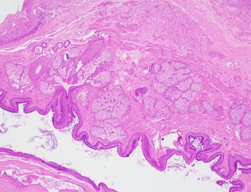 Dermoid cyst (mature cystic teratoma) (Ovary)
