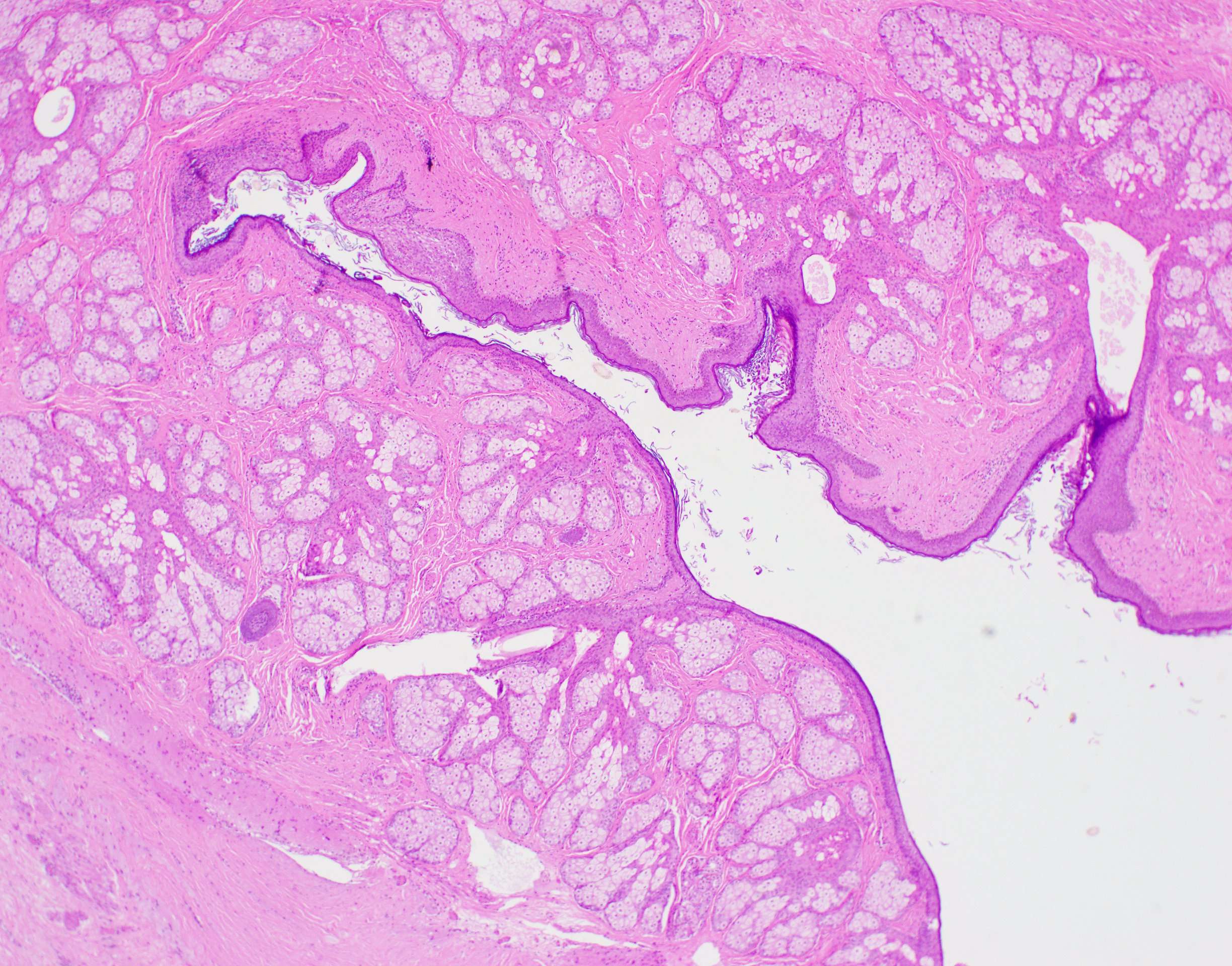 Cystic mature teratoma 4x 2