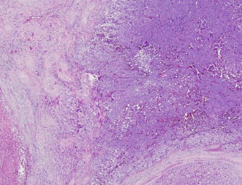 Malignant primary Leydig cell tumor (testis)
