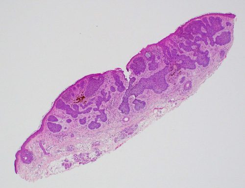 Basal cell carcinoma (skin)