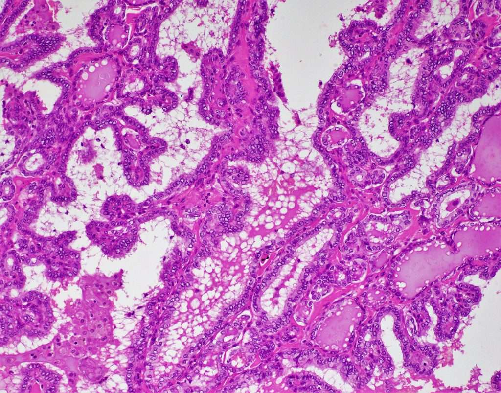 Papillary Thyroid Carcinoma Bosnianpathology