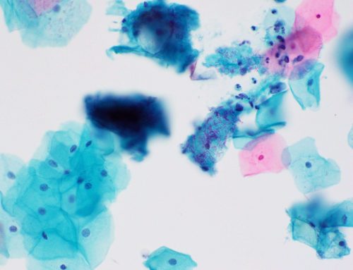 Lactobacillus (The BD SurePath liquid-based Pap Test)