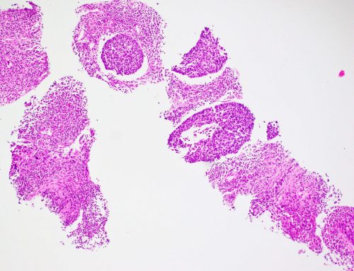 Squamous cell carcinoma (basaloid variant) (lung)
