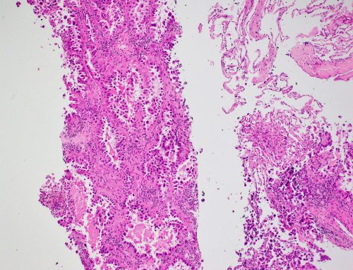 Pulmonary adenocarcinoma with lepidic growth pattern