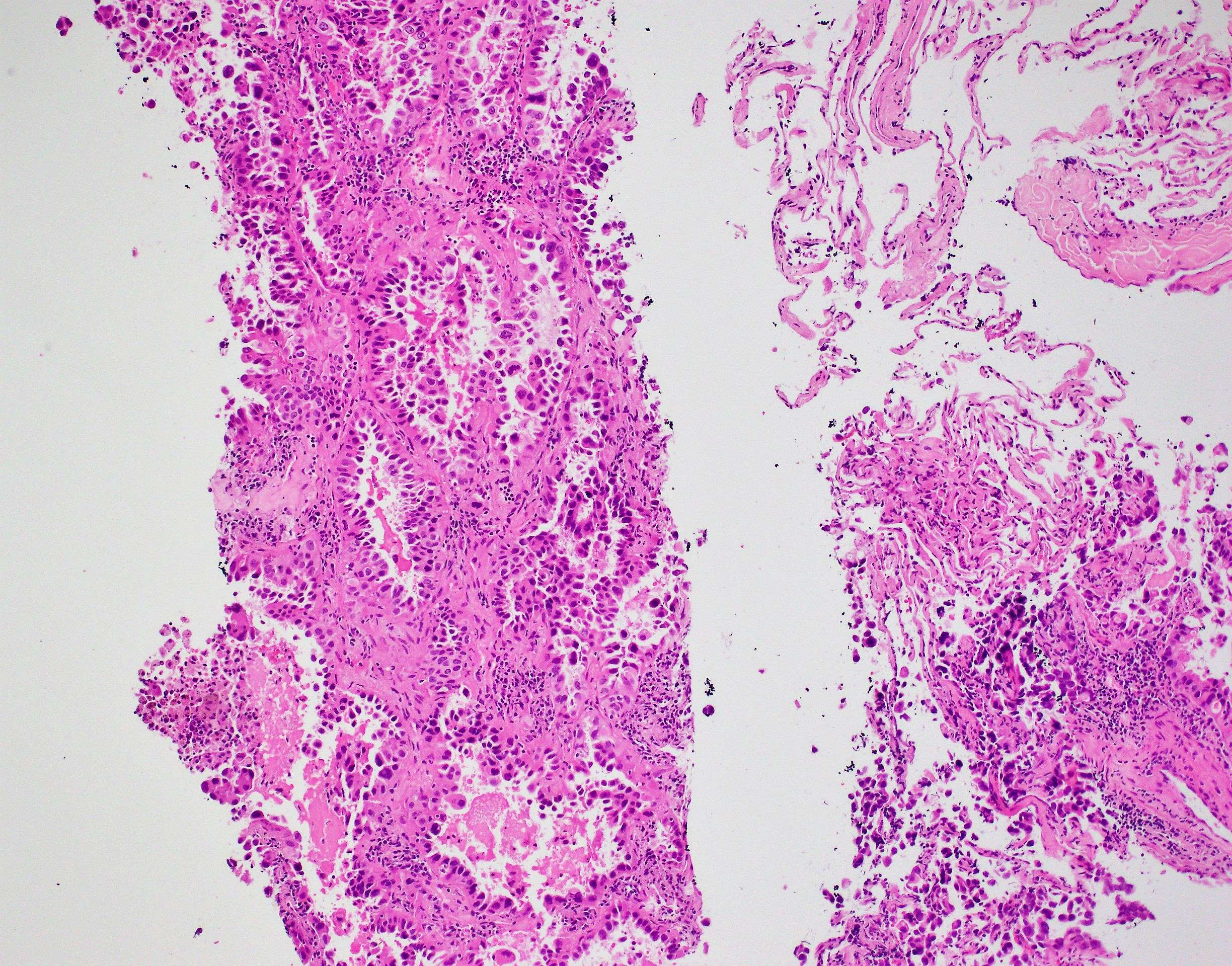 adenoca lung lepidic growth pattern 10x
