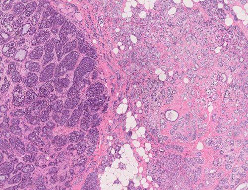 Salivary gland-type breast cancer