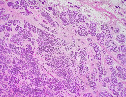 Adenoid cystic carcinoma (breast, low grade)