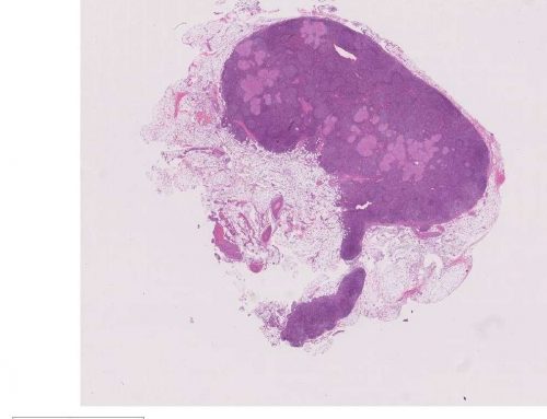 Granulomatous lymphadenitis (cervical lymph node, probably TB)