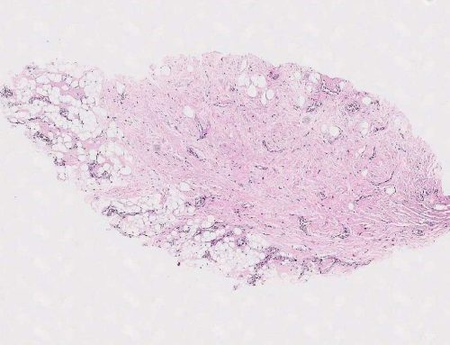 Angiolipoma (male breast, core biopsy)*